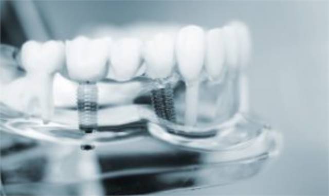 Dental Implants in Plano TX | Implant Dentist Plano | Shine and Sparkle Dentistry