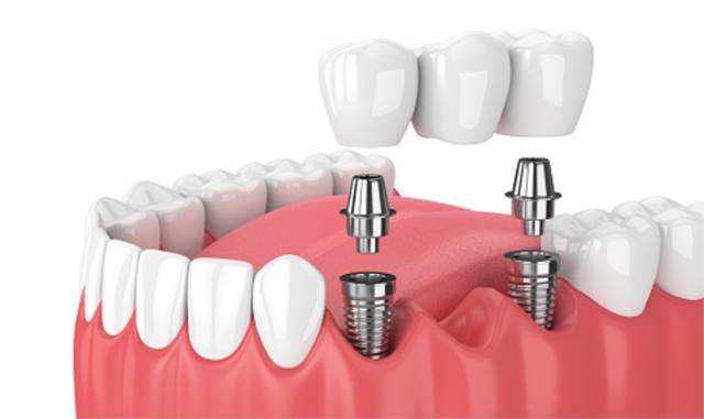 Dental Implants in Colleyville | Implant Dentist Colleyville | Dentist Near Me | Serene Dental 