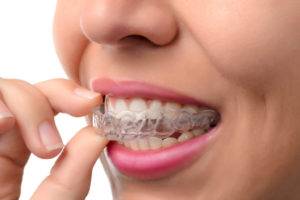 Dental Veneers in Midtown TX | Floss Dental - Midtown Houston TX