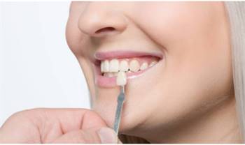 Dental Veneers to improve how your teeth look
